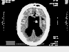 CT scan of the brain of Theresa Schiavo. Dark areas indicate reduced activity.